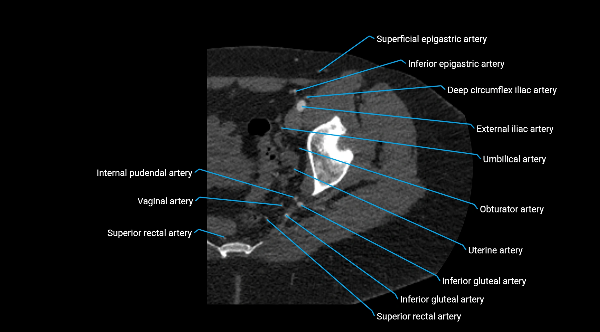 CTA lower limb cross sectional anatomy labelled image _47.webp